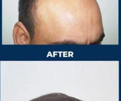 Best Cosmetic Surgeon Hyderabad | Personiks Skin & Hair Care