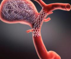 Aneurysm Coiling for Safe and Effective Brain Care