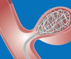 Coil Embolization Procedure for Brain Aneurysm Treatment