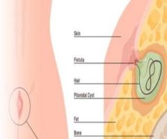 Advanced Care Solutions for Piles and Anorectal Health Issues