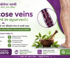 Effective Varicose Veins Treatment in Ayurveda for Natural Relief